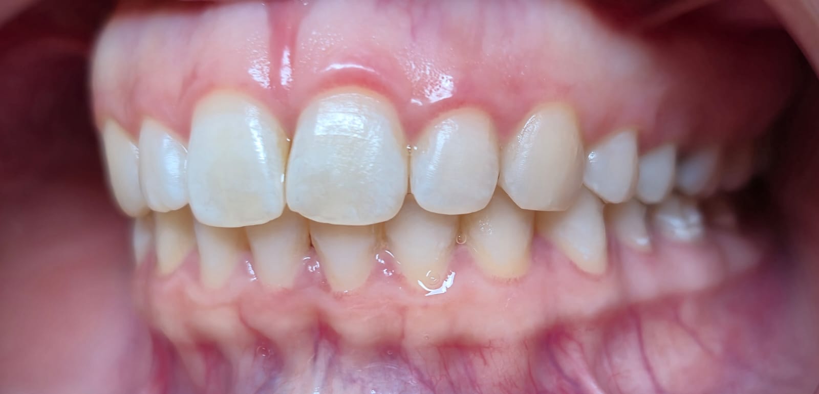 Blanqueamiento dental