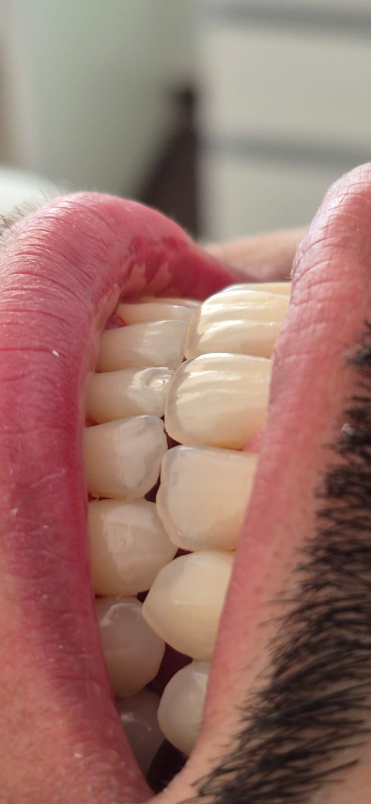 Limpieza y prevención dental